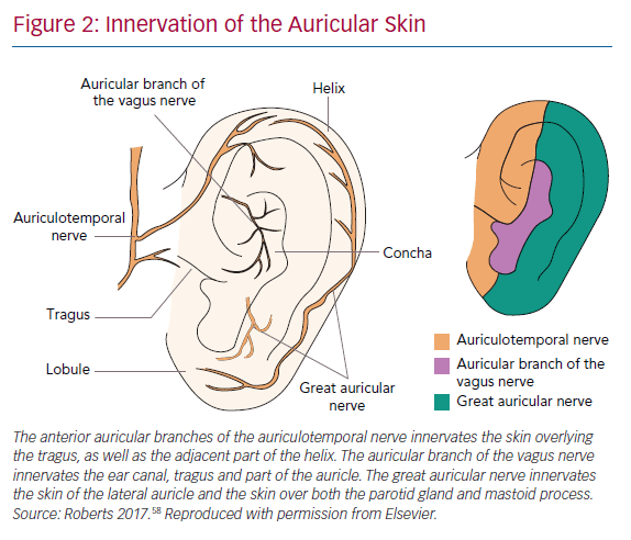 Auricular VNS: A Breakthrough in Neurological Health